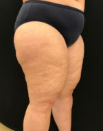 Thigh Lift