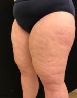 Thigh Lift