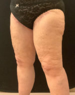Thigh Lift