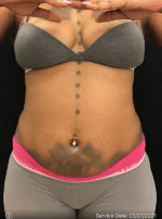 Liposuction