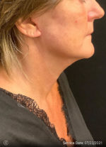 Facelift