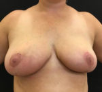 Breast Reduction