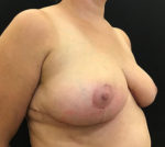 Breast Reduction