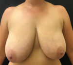 Breast Reduction