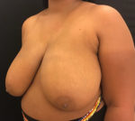 Breast Reduction