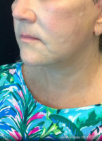 Facelift