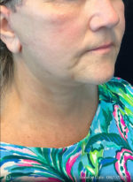 Facelift