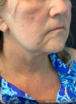 Facelift