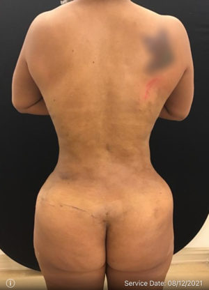 Liposuction