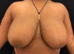 Breast Reduction
