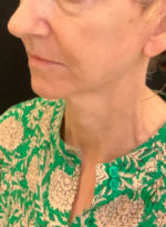 Facelift