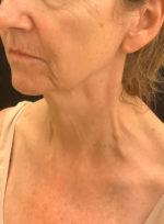 Facelift