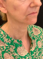 Facelift