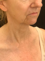 Facelift
