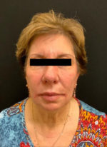 Around The Eye Fillers