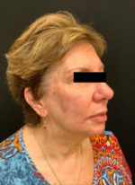 Around The Eye Fillers