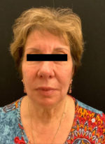 Around The Eye Fillers