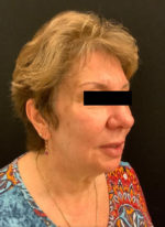 Around The Eye Fillers