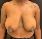 Breast Lift