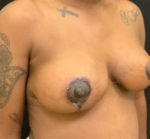 Breast Lift