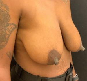 Breast Lift
