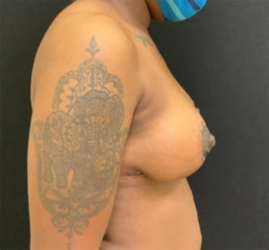Breast Lift