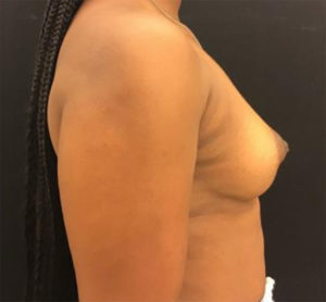 Breast Lift