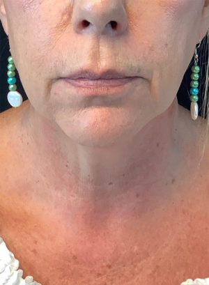 Around The Mouth Fillers