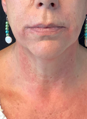 Around The Mouth Fillers