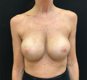Breast Revision