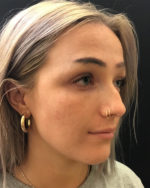 Nose Surgery