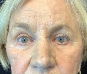 Upper Eyelid Blepharoplasty