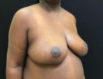 Breast Reduction
