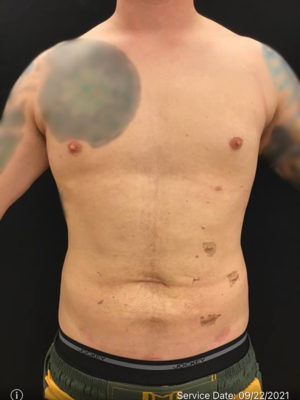 Liposuction for Men
