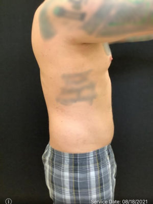 Liposuction for Men