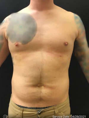 Liposuction for Men