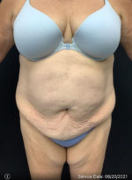 Tummy Tuck