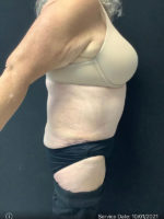Tummy Tuck