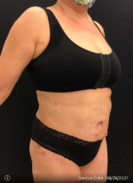 Tummy Tuck