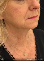 Facelift