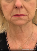 Facelift