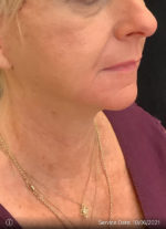 Facelift