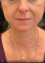 Facelift