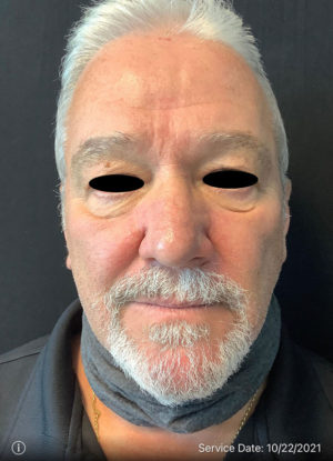 Around The Eye Fillers