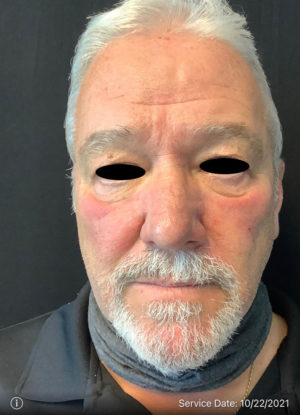 Around The Eye Fillers