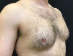 Gynecomastia