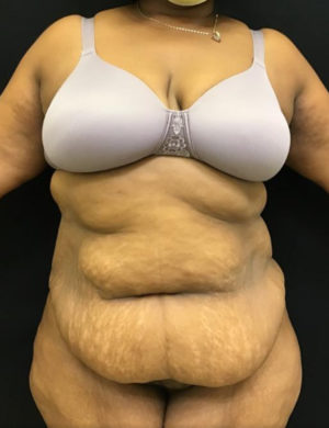 Tummy Tuck