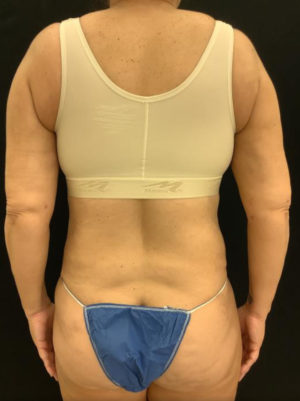 Liposuction