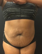 Liposuction