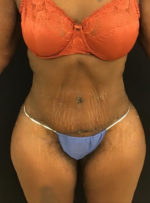 Tummy Tuck